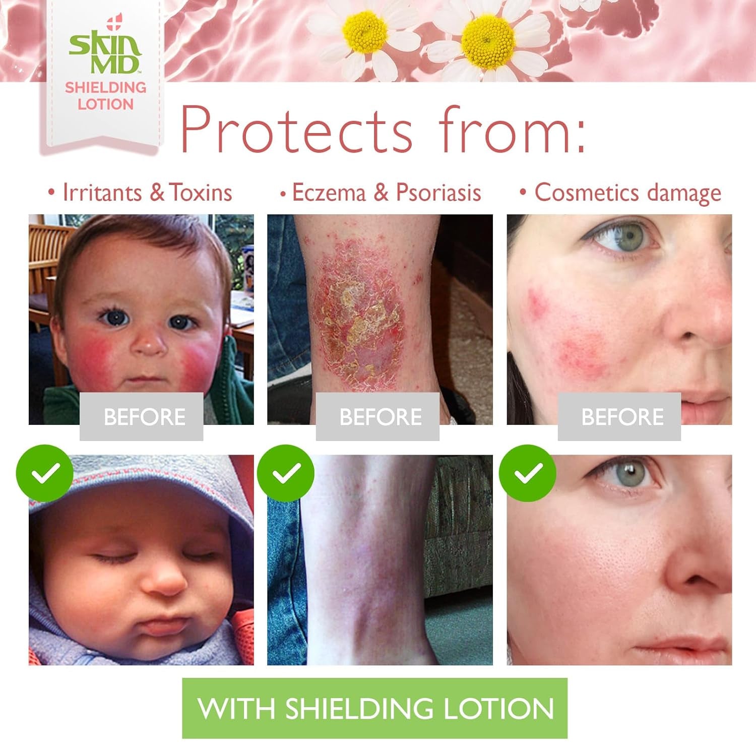 Shielding Lotion for Face, Body & Hands 8Oz with Dispenser- Helps with Eczema & Psoriasis! the Natural Dry Skin Remedy to the Things That Dry Your Skin