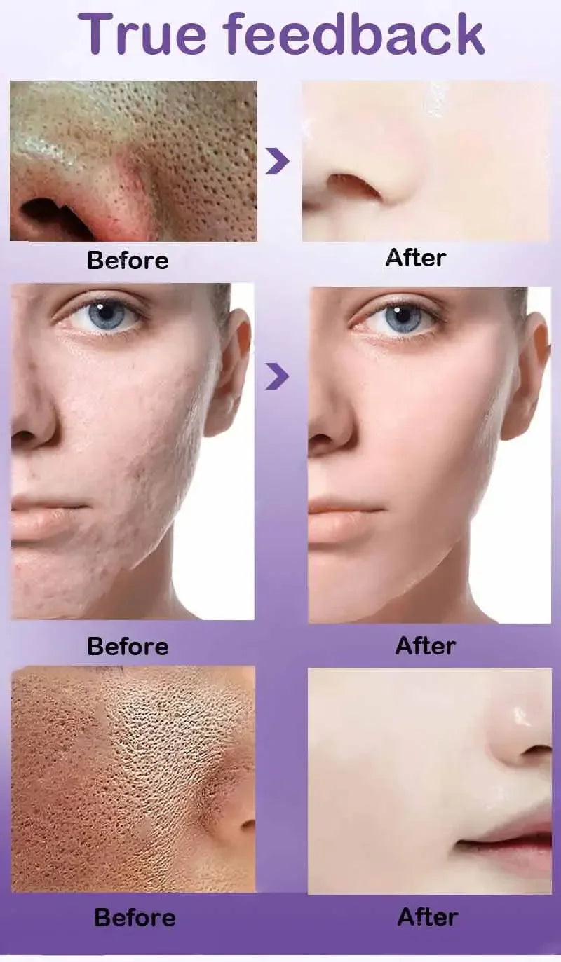 Suéro Facial con Retinol y Niacinamida – Reductor de Poros, No Comedogénico 10ml