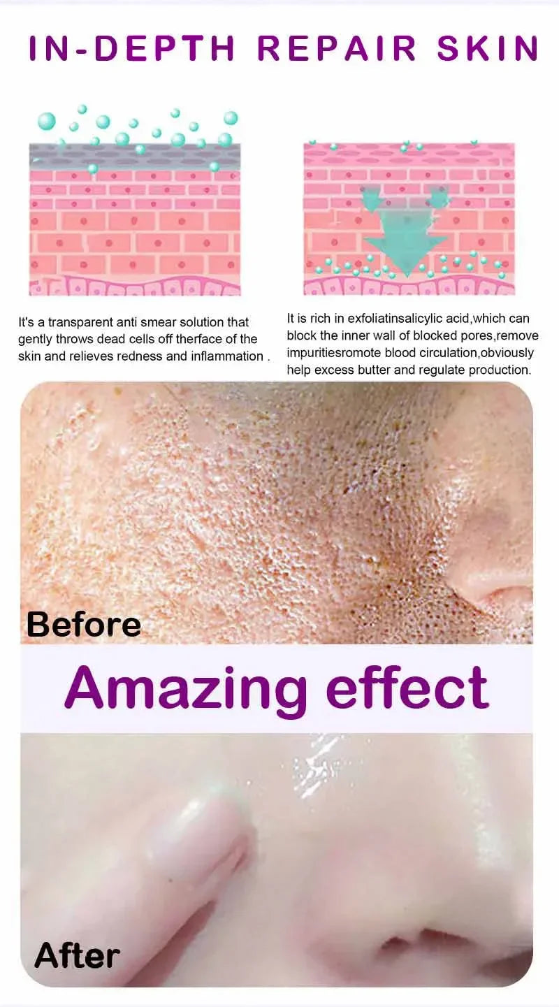 Suéro Facial con Retinol y Niacinamida – Reductor de Poros, No Comedogénico 10ml