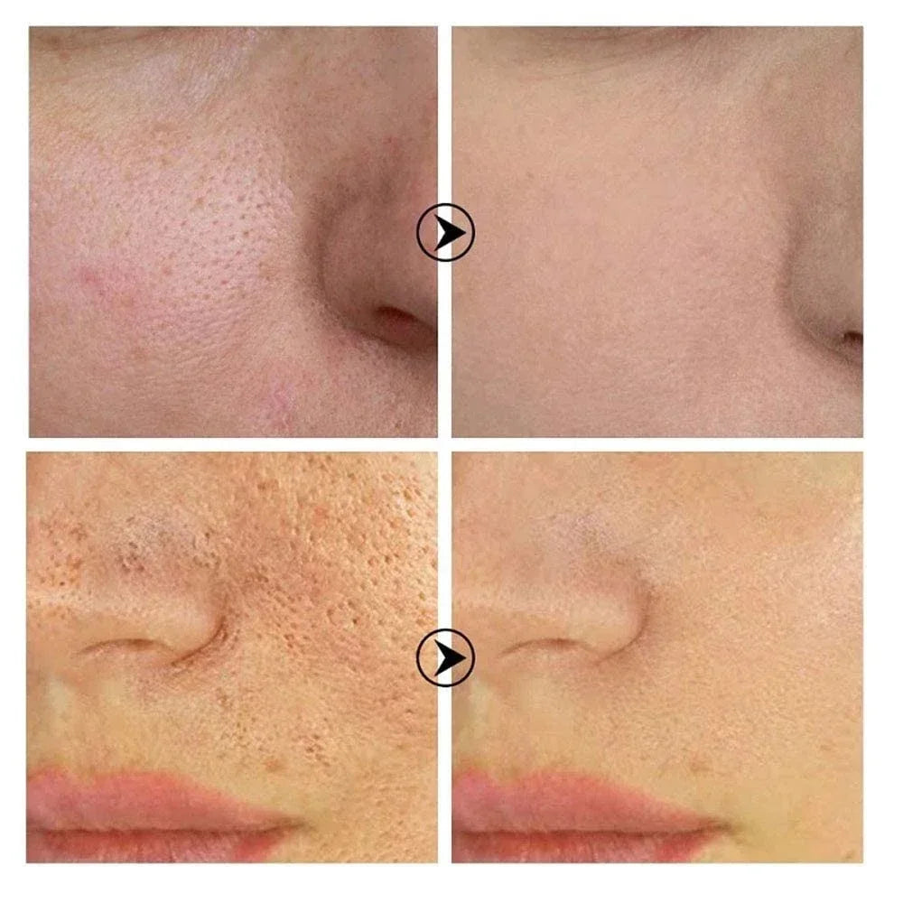 Suéro Facial con Retinol y Niacinamida – Reductor de Poros, No Comedogénico 10ml