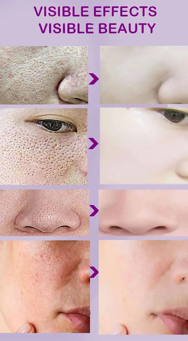 Suéro Facial con Retinol y Niacinamida – Reductor de Poros, No Comedogénico 10ml